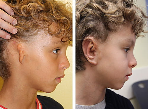This boy was treated for microtia at Cincinnati Children’s. Photos show before (left) and after ear reconstruction surgery.